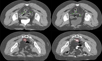 Lynch Syndrome-Associated Endometrial Cancer With Combined EPCAM-MSH2 Deletion: A Case Report